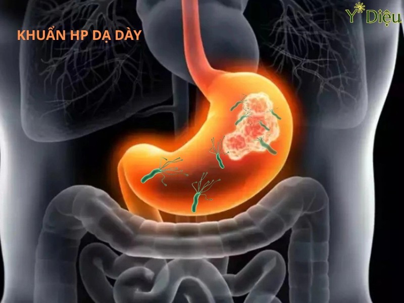 Vi Khuẩn HP Là Gì? Chúng Có Nguy Hiểm Gì Cho Dạ Dạy